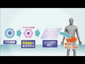 『ｉＰＳ細胞』から“膵臓の組織”を作製し移植 「１型糖尿病」患者への治験を来年にも開始 京都大学附属病院（2024年9月2日）