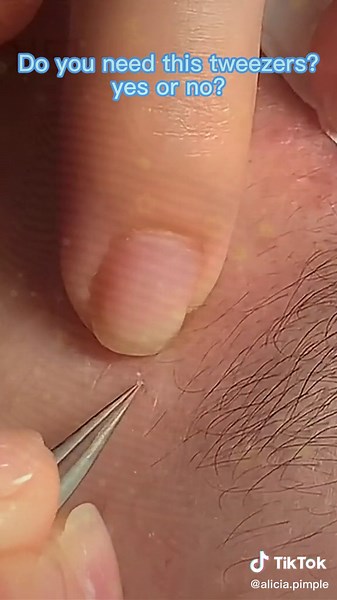 #pimplepop #acnetreatment #pimplepopper #pimplepopper2021 #cystpopping #satisfyingvideo #pimple #pimplepopper2022 #skincare #fyp #removal