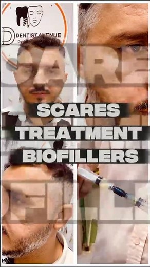 Scares Treatment Bio fillers #dentistavenue #biofillers #skincare