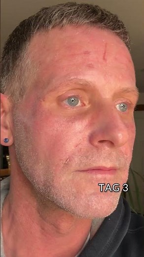 So verläuft der Heilungsprozess nach dem CO2-Laser – Tag für Tag!