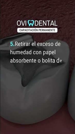 CLORHEXIDINA EN ODONTOLOGÍA RESTAURADORA. Protocolo de aplicación de adhesivos convencionales