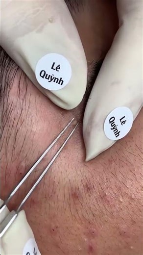 A/c cần tư vấn da hoặc mua sản phẩm L.h Fanpage Viện Thẩm Mỹ LQSPA hoặc Ze.lo 0356.79.33.49