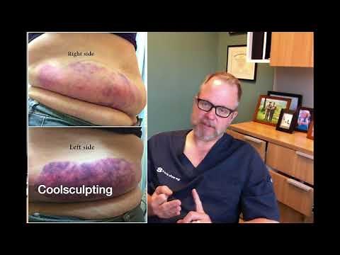 Sculpsure vs Coolsculpting - Which One is Better?