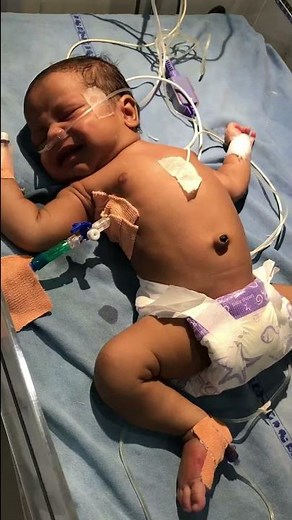 Pneumothorax | intercostal drainage placement | Pediatrics | #newborn #shorts #babyvideos #doctor