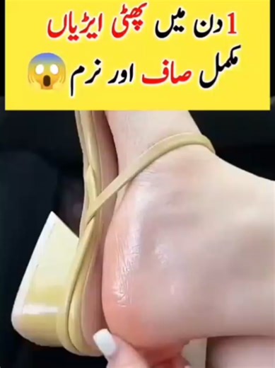Cracked Heel Home Treatment & Care