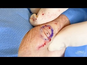 A Beautiful Cyst (Underarm Cyst Removal)| CONTOUR DERMATOLOGY