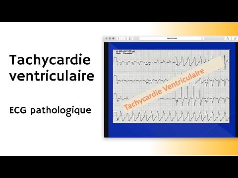 # Tachycardie ventriculaire # ECG pathologique # arythmie