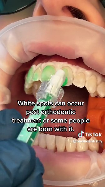 What is the ICON Treatment? It’s a non invasive, no anesthesia needed treatment to improve the appearance of white spots on the teeth. Plush Dentistry is one of the select few offices in the Dallas/Fort Worth area to offer this treatment. Contact us today for your consultation 🦷 PLUSH DENTISTRY COSMETIC | FAMILY DENTISTRY 5285 Dallas Pkwy Suite 515 Frisco-75034 ☎️ 469-850-0786 #friscodentist #dallasdentist #veneers_smile #friscotx #friscotexas #smilemakeover #veneersdallas #bestdentist #familyd