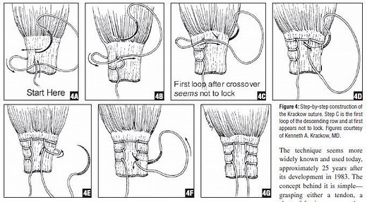 Krackow Suture Technique