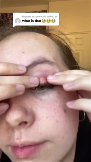 Replying to @PRO 14 #pimples #cyst #cystpopping #dila #acne #zit #zithappens #zitpimples #fyp #foryou #viral #blackhead #satysfying #satisfyingvideo #fypシ #viralvideo #cystremoval