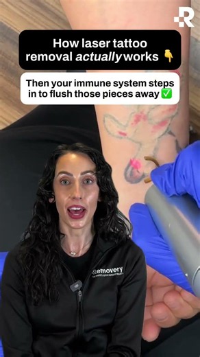 How Does Laser Tattoo Removal Work? 🧬 #Shorts