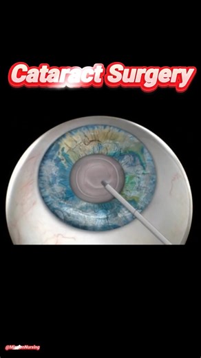 The Exact Steps of Cataract Surgery #surgery #eyecare