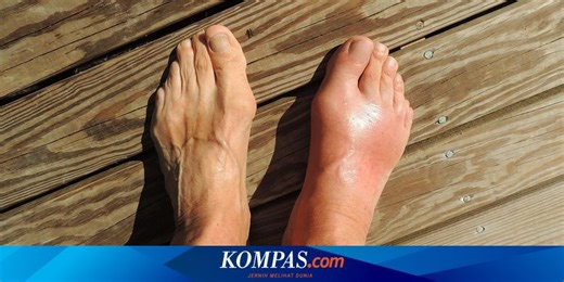 Benarkah Edema dan Tophus Tanda Kerusakan Ginjal? Ini Penjelasan Dokter