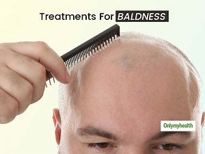 5 Popular Methods To Treat Baldness In Men