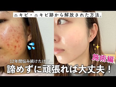 【ニキビ肌】小学生から悩み続けた、ニキビ・ニキビ跡に効果のあったおすすめの施術を紹介します✨