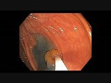 Colonoscopy Channel - How To Perform EMR - Lesion B • Video • MEDtube.net