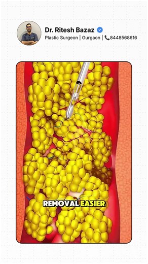 How Liposuction Actually Works! 😮 #liposuction