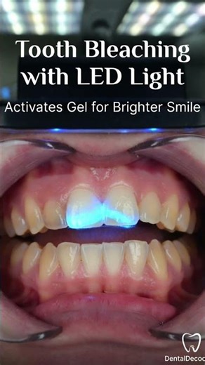 Want to Whiten Your Teeth? 3 Clinic Methods You Must Know! #dental #dentalcare #shorts