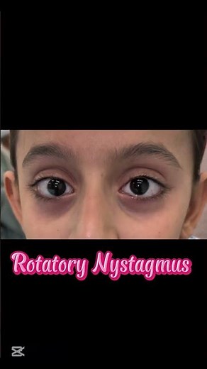 Rotatory Nystagmus/Nystagmus #ophthalmology #eyes #optometry #doctor