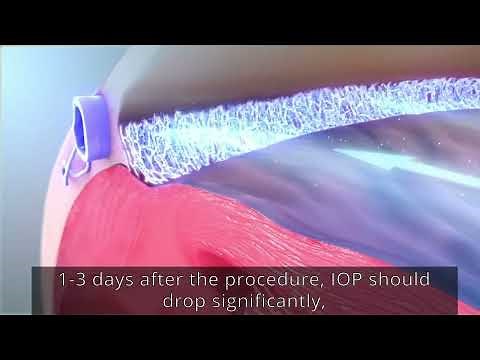 What is Selective Laser Trabeculoplasty (SLT)? SLT laser treatment for glaucoma