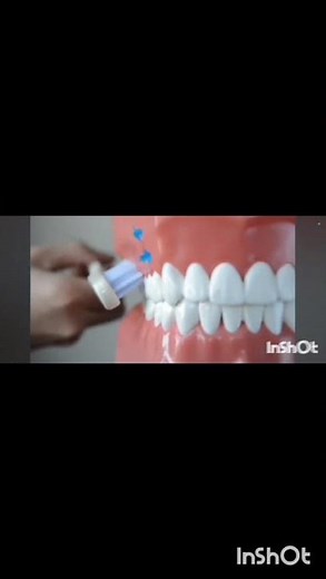 MODIFIED STILLMAN BRUSHING TECHNIQUE
