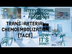 What Is TACE ? How It's Done? Trans-arterial chemoembolization (TACE) #Chemo