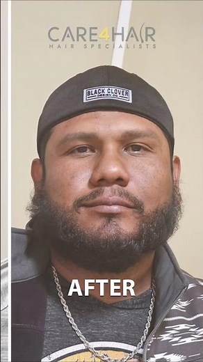 Amazing Beard Transplant Before and After