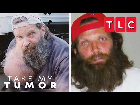 Tim's Story | Take My Tumor | TLC