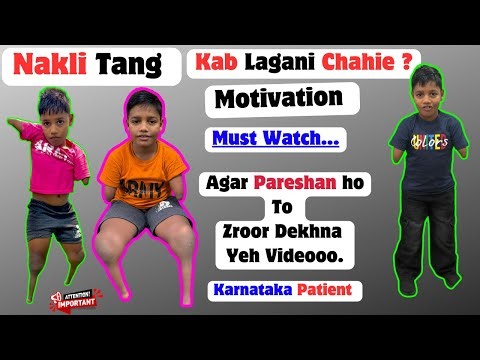 Below Knee Artificial Leg | Above Knee Prosthetic Leg | Nakli Hath | Bionic Hand | #ossur #ottobock