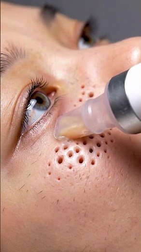 Ultra HD Pore Vacuum Gentle Cheek Blackhead Removal