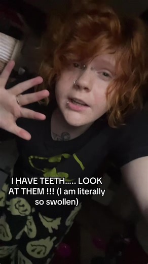 My Post-Procedure Journey: First Day with Dentures