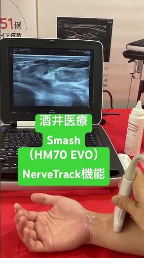 Smash （HM70 EVO） NerveTrack機能 第8回日本リハビリテーション医学会秋季学術集会