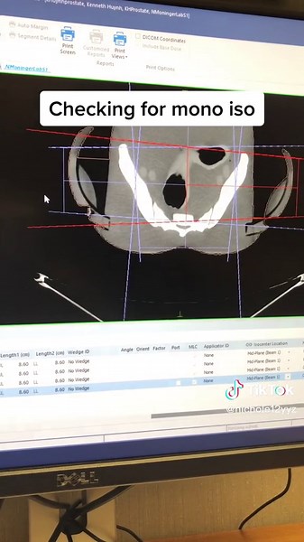 #radiationtherapy #radiationtherapist Checking for mono isocenter using Elekta Monaco Sim in an academic setting (4-field box pelvis/prostate)