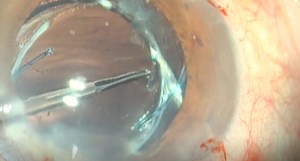 IOL Optic Transplant - Eyetube
