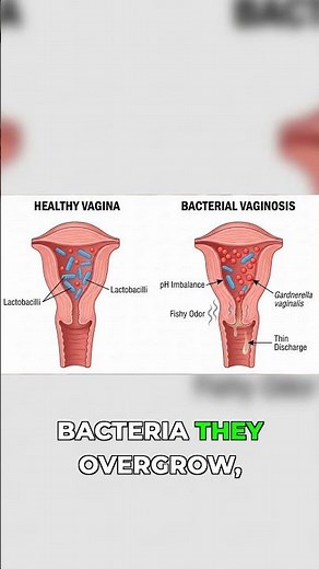 Understanding BV: Symptoms, Causes, and What it Is