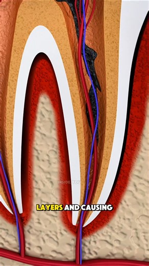 96K views · 154 reactions | Cavity Filling and Tooth Decay Removal Procedure Explained #ToothRestoration #toothdecay #DentalCare #InsideYou360 #Medinside360 | pharmacy.phil | Facebook