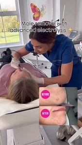 11 reactions | A quick, safe and effective way to remove unwanted moles with advance electrolysis ⚡️Minimal downtime, Maximum Confidence ‍♀️ #MoleRemoval #AdvancedElectrolysis #SkinTreatment #AestheticsUk | Pure Skin Aesthetics Clinic | Facebook