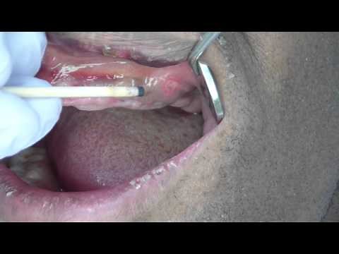 Denture Sore Spots Thompson Sticks