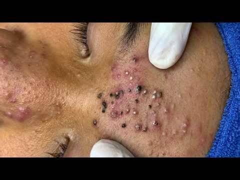 Blackhead Removal With Sac Dep Spa @749