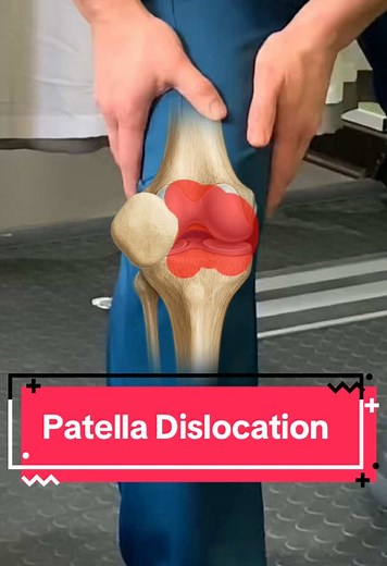 Understanding Patella Dislocation and Recovery