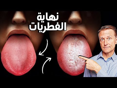 طريقة أفضل للتخلص من الكانديدا والفطريات