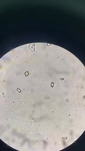 Urine sample ❤️🔬 #urinecrystal #uricacid crystal. #lablife #medicallaboratory .#microbiology | Lab life