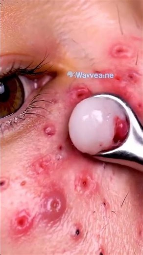 Insane Acne Extraction You’ve Never Seen Before 😱 #blackheadcaique #pimplepopping #satisfying