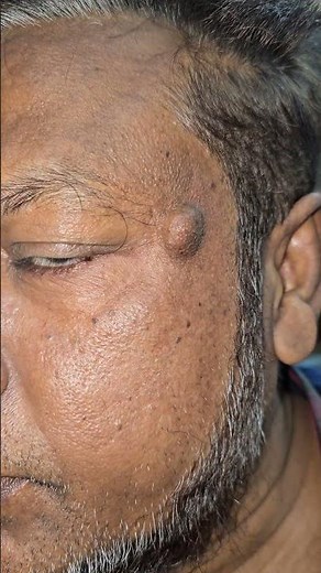 Sebaceous cyst