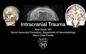 Imaging of Intracranial trauma(720P_60FPS)