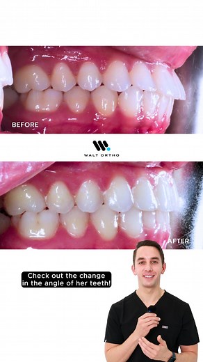 Invisalign Smile Transformation for Better Alignment