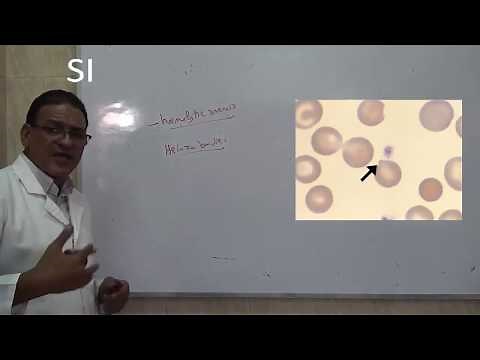 أنيميا الفول I Favism I الأسباب والأعراض