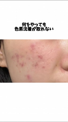 ニキビ跡を秒で消す方法【ビフォー・アフター】