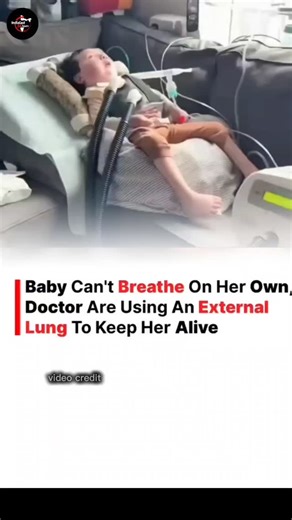 indialast24_hours on Instagram: "This newborn baby’s lungs were too fragile to function on their own, so doctors placed her on ECMO — a life-support machine that works like an external lung. It carefully adds oxygen to her blood, removes carbon dioxide, and gives her tiny body the time it needs to heal and grow stronger. Every single moment on ECMO is critical, but she is gradually showing signs of improvement thanks to dedicated doctors, advanced medical technology, and constant monitoring. Her