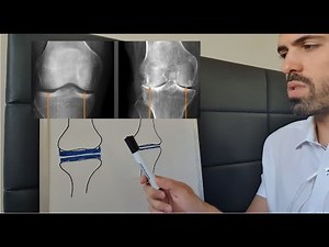 X-ray in Osteoarthritis - Osteophyte Formation and Sclerosis